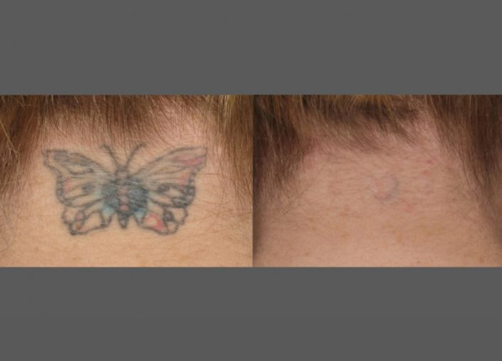  înlăturarea tatuajului cu laser rezultat - fluture 