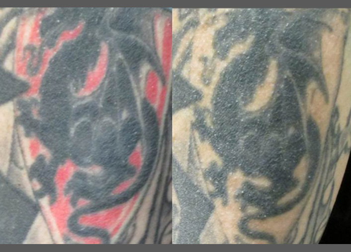 rezultatul înlăturării culorii rosii cu laser